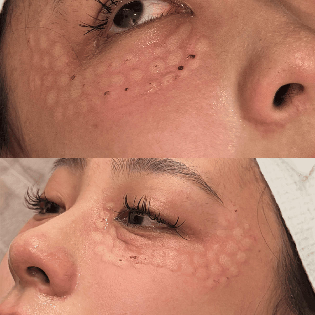 【首爾醫美推薦】明洞奧緹娜 Otena Clinic 實測:眼下麗珠蘭告別黑眼圈,美版超聲刀拉出逆天下顎線! - 第2張圖 【首爾醫美推薦】明洞奧緹娜 Otena Clinic 實測:眼下麗珠蘭告別黑眼圈,美版超聲刀拉出逆天下顎線!