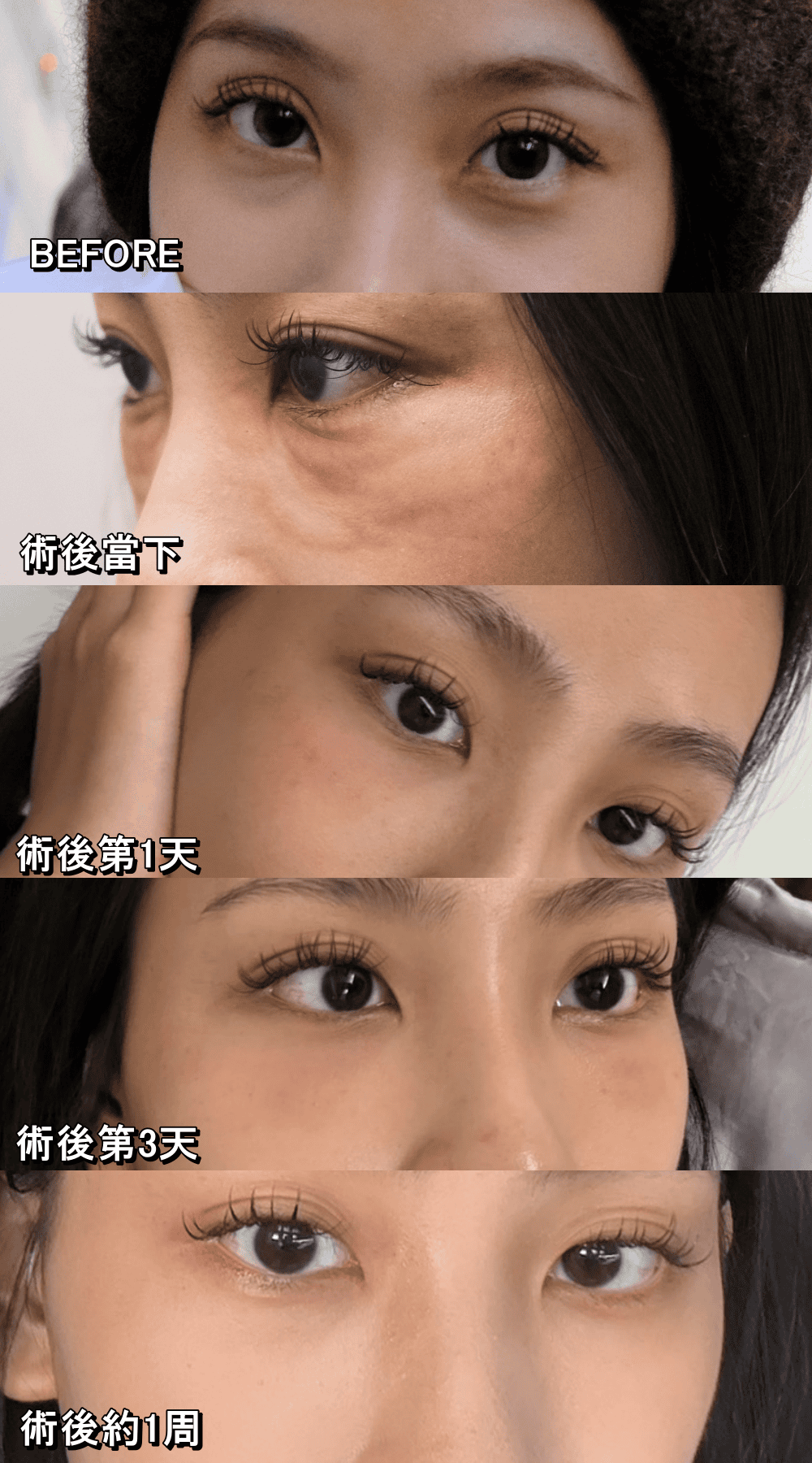 【首爾醫美推薦】明洞奧緹娜 Otena Clinic 實測:眼下麗珠蘭告別黑眼圈,美版超聲刀拉出逆天下顎線! - 第1張圖 【首爾醫美推薦】明洞奧緹娜 Otena Clinic 實測:眼下麗珠蘭告別黑眼圈,美版超聲刀拉出逆天下顎線!