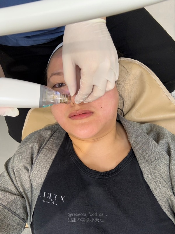 【首爾醫美推薦】江南詩麗雅 Xenia Clinic 實測|雙下巴救星ONDA、麗珠蘭機打黃金微針,價格透明不推銷! - 第28張圖 【首爾醫美推薦】江南詩麗雅 Xenia Clinic 實測|雙下巴救星ONDA、麗珠蘭機打黃金微針,價格透明不推銷!