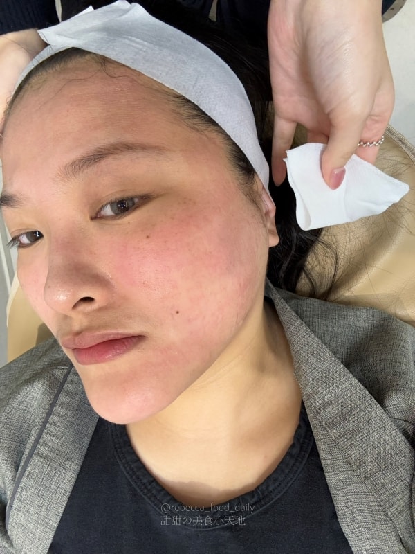 【首爾醫美推薦】江南詩麗雅 Xenia Clinic 實測|雙下巴救星ONDA、麗珠蘭機打黃金微針,價格透明不推銷! - 第26張圖 【首爾醫美推薦】江南詩麗雅 Xenia Clinic 實測|雙下巴救星ONDA、麗珠蘭機打黃金微針,價格透明不推銷!